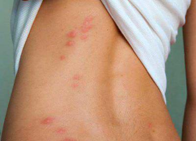 درمان گیاهی بیماری گال چگونه است؟