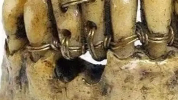 ارتودنسی دندان ها در مصر باستان
